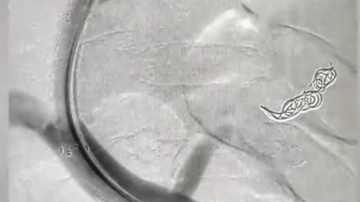 SEAH GİRİŞİMSEL RADYOLOJİ KLİNİĞİNDE İLK DEFA VARİS KANAMALARININ VE KARINDA