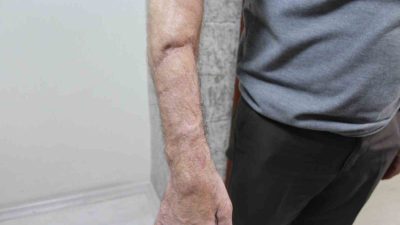 İŞ KAZALARINDA CİDDİ YARALANMALAR YAŞAYAN İKİ HASTA SEAH ORTOPEDİ KLİNİĞİNDE