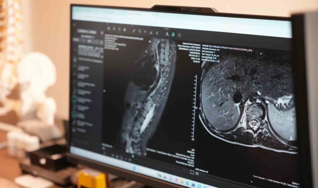 Omurganın yana doğru eğilmesiyle ortaya çıkan skolyoz, özellikle çocukluk ve