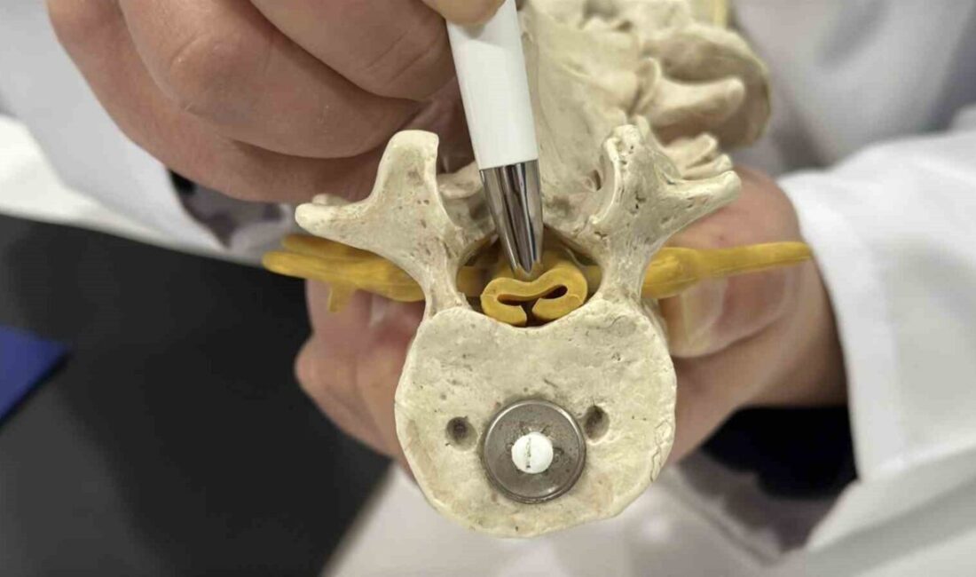 Bel fıtığıyla benzer belirtiler gösteren ve tedavi edilmediğinde kalıcı hasarlara