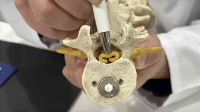 Bel fıtığıyla benzer belirtiler gösteren ve tedavi edilmediğinde kalıcı hasarlara