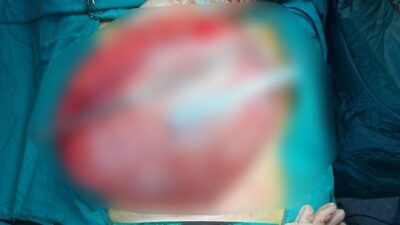 Bolu’da fazla kilolarından kurtulmak amacıyla hastaneye başvuran 14 yaşındaki lise